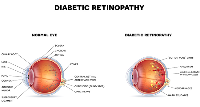 Nornal eye and diabetic retinopathy