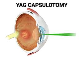 YAG Laser Treatment