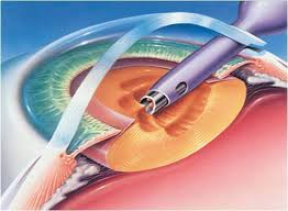 Cataract Surgery