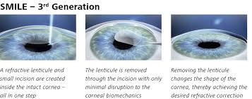 Smile Laser procedure