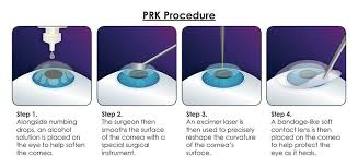 PRK Laer procedure