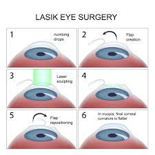 Lasik Laser procedure