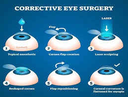 Corrective eye surgery process