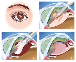 Benefits of laser cataract surgery