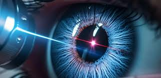 lasik eye surgery