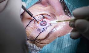 Eye surgery 