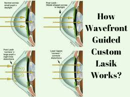 Lasik eye surgery work
