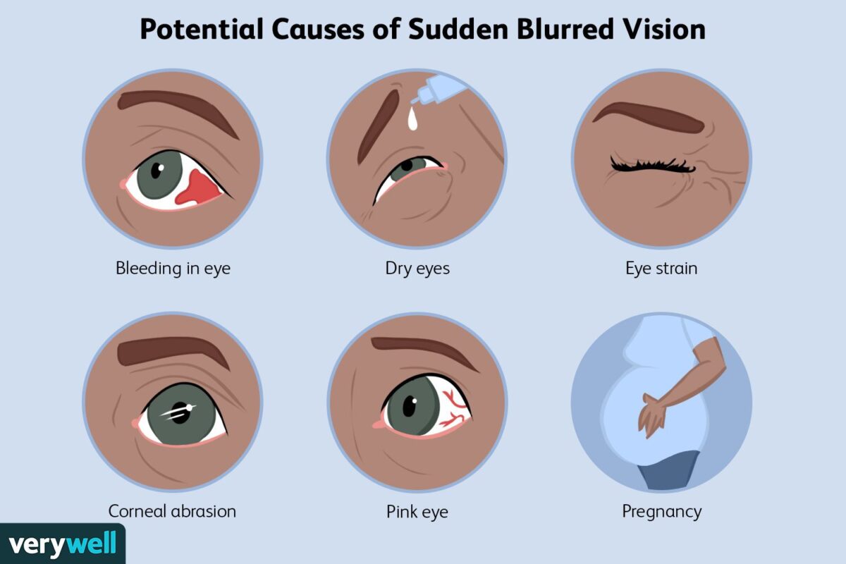 Common causes of blurred vision during pregnancy 