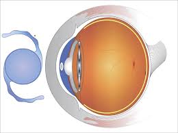 Toric Lens for cataract surgery