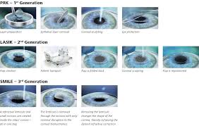 Type of Laser eye surgery