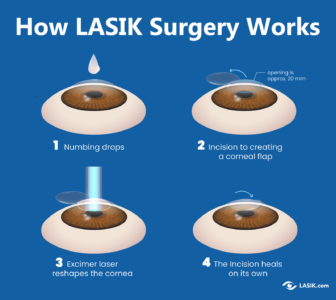 lasik eye surgery