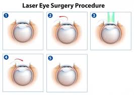 Laser eye Surgery procedure