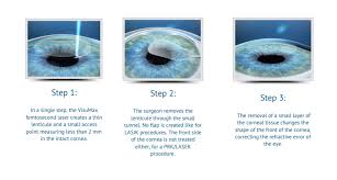 Smile eye surgery procedure