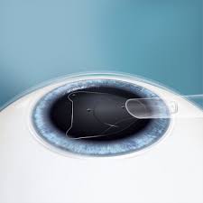 EVO Eye Surgery