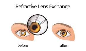 Refractive Lens Exchange in Eyesight Operation