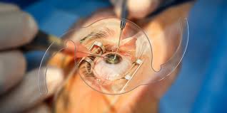 IOL Eye Surgery