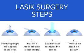 Lasik Eye Surgery