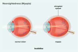 Myopia eye