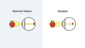 Myopia Eye