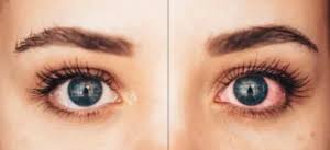 After Recovery Contoura Laser Eye Surgery