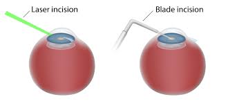 Laser cataract eye surgery process