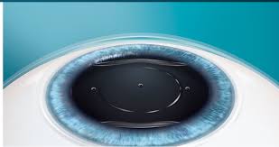 ICL Eye Surgery