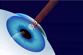 Silk Laser Eye Surgery