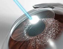 Femto eye surgery for vision