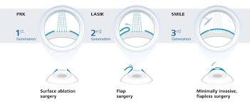 Type of laser eye Surgery