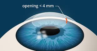 Lasik eye surgery Smile