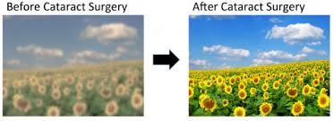 Before and after cataract Surgery