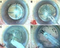 cataract treatment in Bangalore
