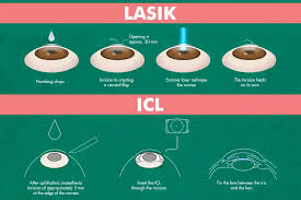 Differences ICL and Lasik Surgery