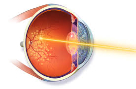 Laser Retina treatment