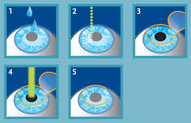 Procedure of Laser eye Surgery