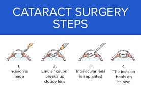 Cataract Surgery Procedure