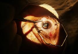 Cataract Surgery recovery time and tips