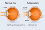Astigmatism