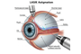 The LASIK Procedure for Astigmatism