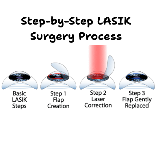 Step-by-step Lasik Surgery procedure for nearsightedness