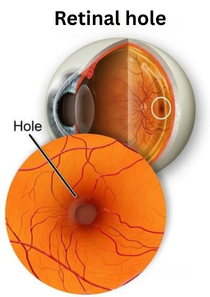 Retinal hole