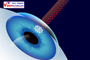Laser Eye Surgery