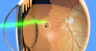 Treatment for retinal detachment