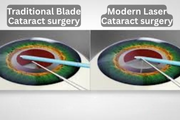Traditional Cataract Surgery vs. Laser Eye Surgery