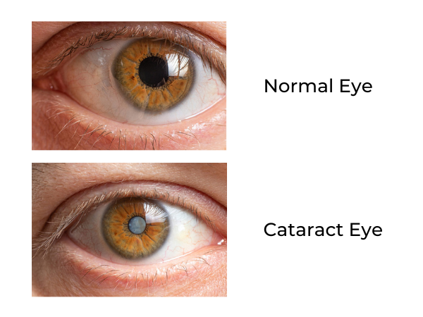 Cataract Eye