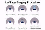 Lasik Eye Surgery Procedure