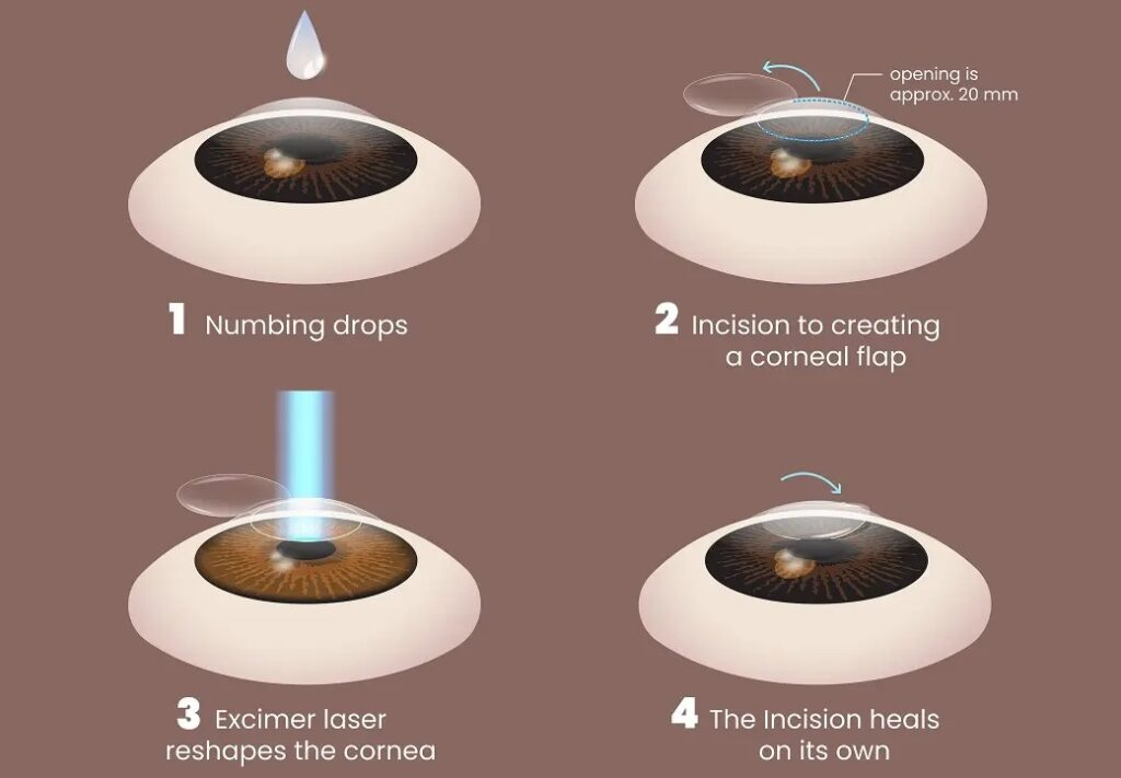 Procedure of Smile eye Surgery