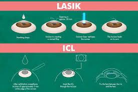 ICL and Lasik Surgery