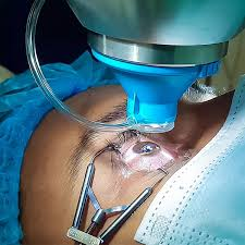 Laser Eye Surgery