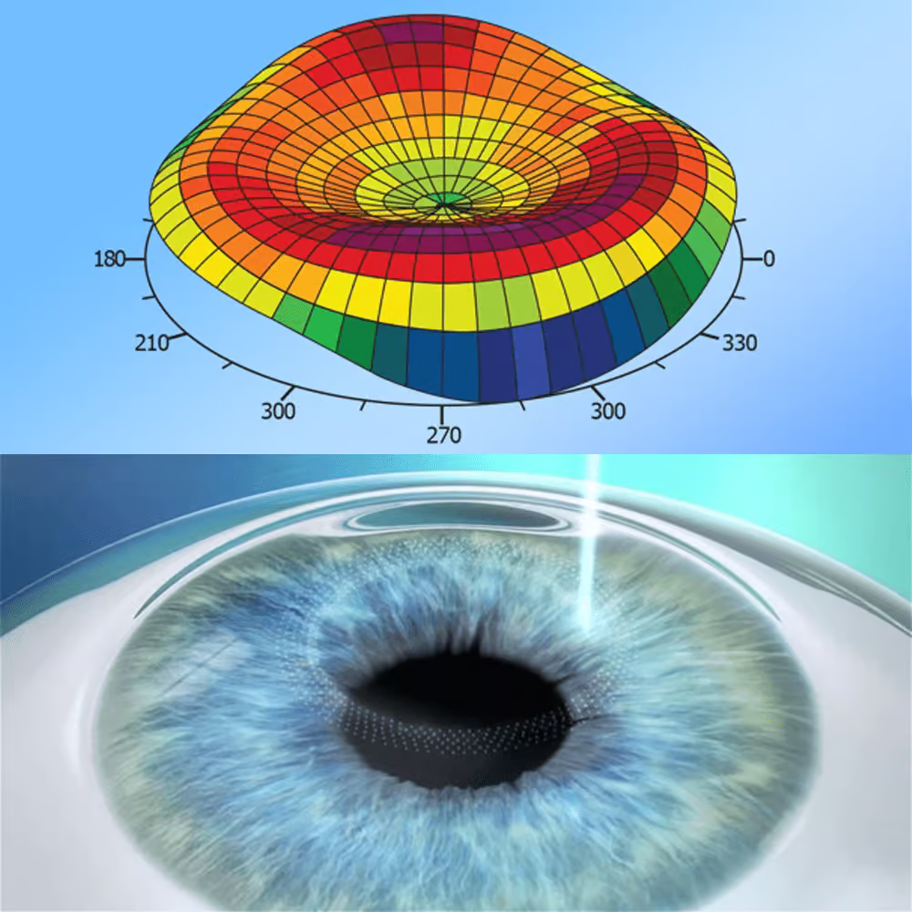 Contoura vision laser eye surgery cost